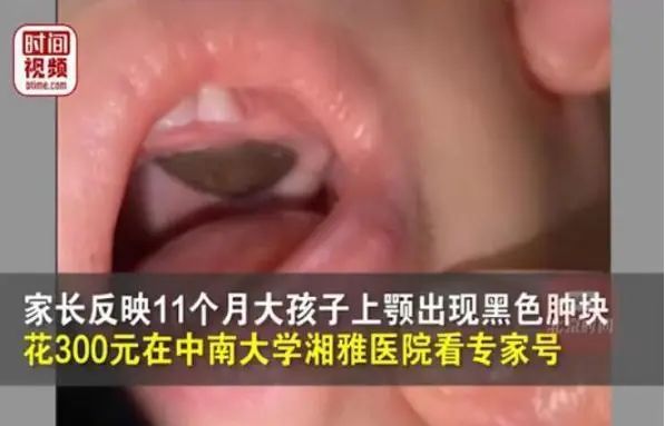 莲子壳粘在儿童嘴里，被专家诊断为肿瘤，湘雅医院回应