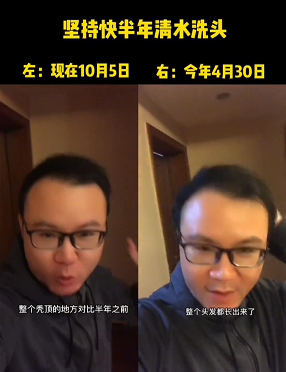 男子不用洗发水从秃顶变满头黑发？当事人：清水洗头只是一方面